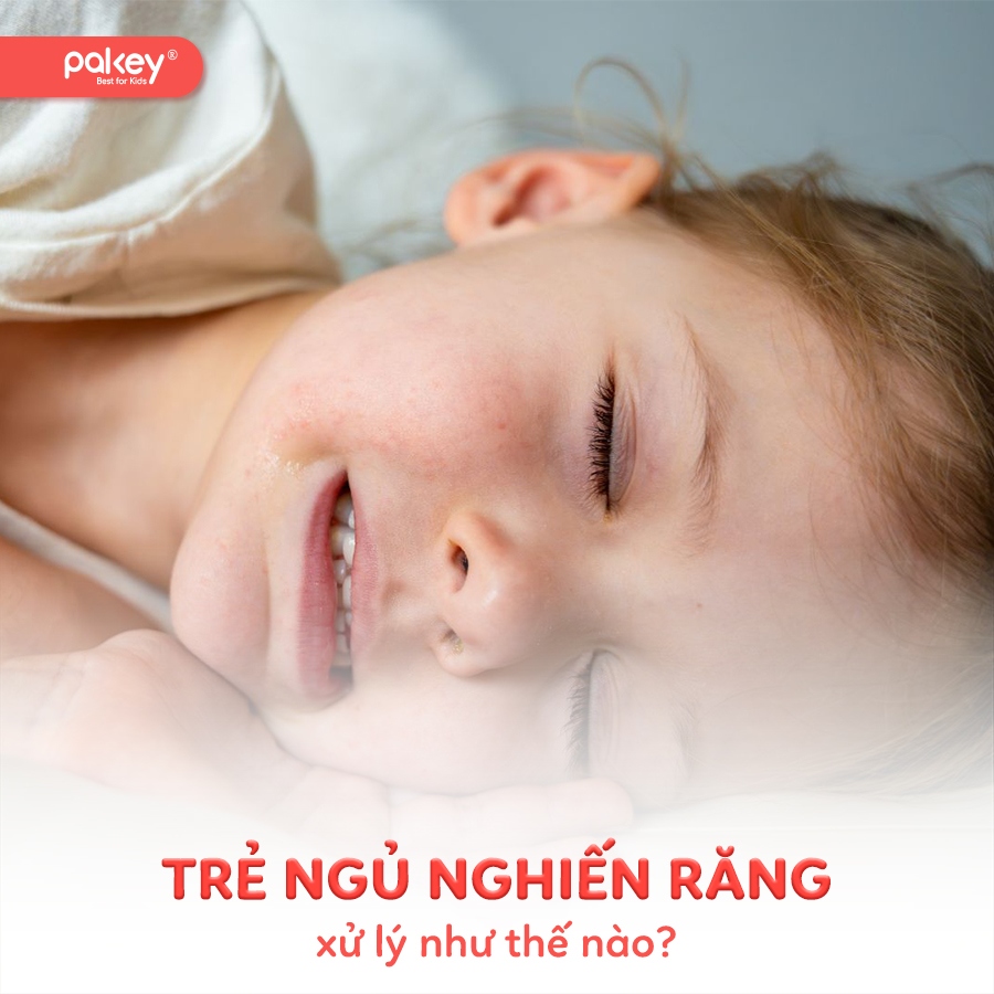 Trẻ ngủ nghiến răng có sao không? Cách xử lý như thế nào?