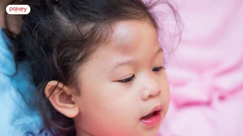 Trẻ ngã u đầu có sao không? Mẹ nên xử lý như nào?