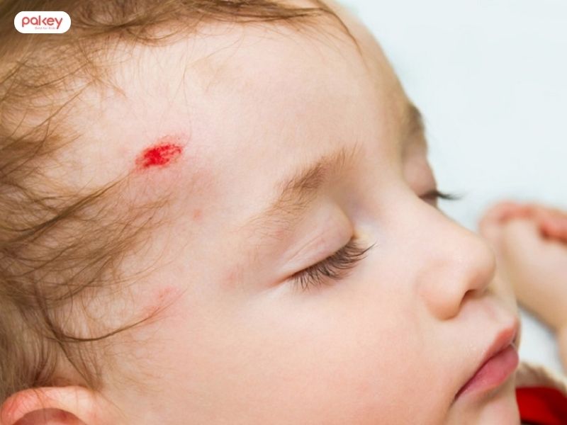 Trẻ ngã u đầu có sao không? Mẹ nên xử lý như nào?