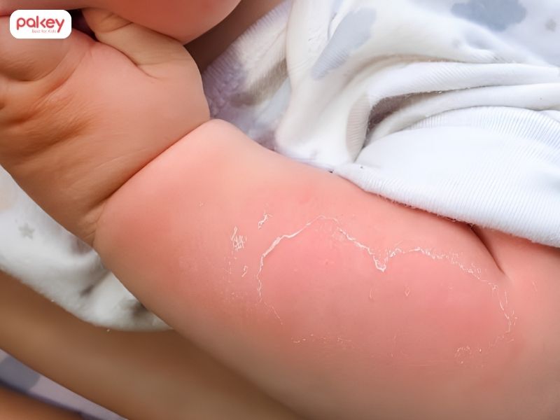 Cách xử lý khi trẻ bị bỏng nước sôi cha mẹ cần biết 9 Cách xử lý khi trẻ bị bỏng nước sôi cha mẹ cần biết