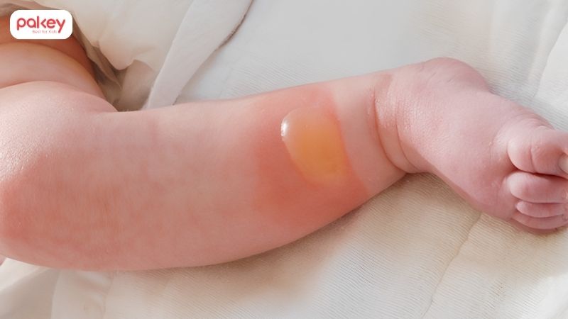 Cách xử lý khi trẻ bị bỏng nước sôi cha mẹ cần biết 10 Cách xử lý khi trẻ bị bỏng nước sôi cha mẹ cần biết