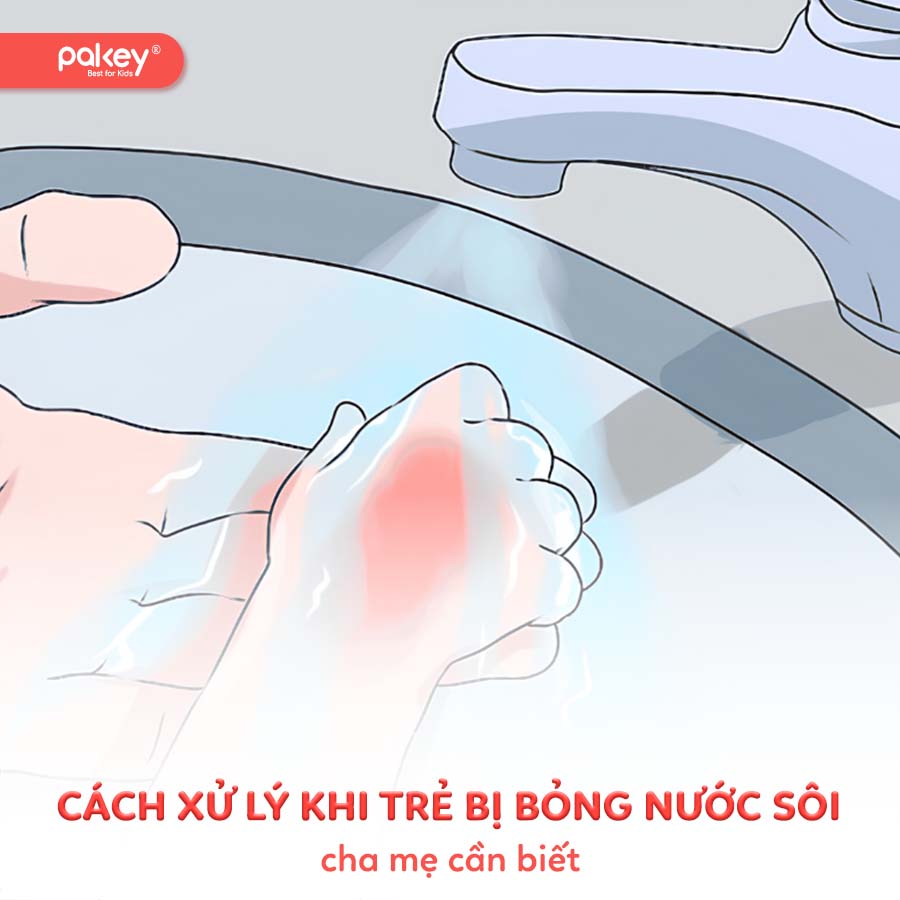 Cách xử lý khi trẻ bị bỏng nước sôi cha mẹ cần biết