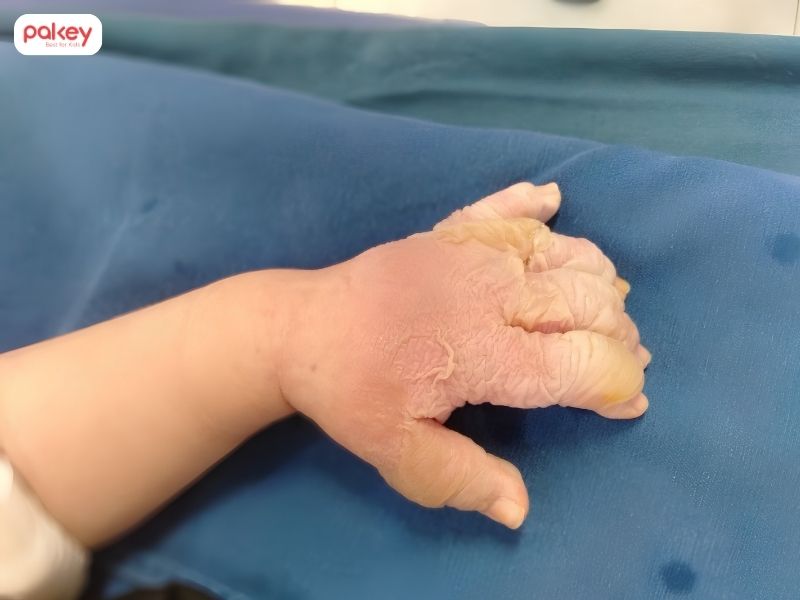 Trẻ bị bỏng phải làm sao và khi nào cần đi viện? 13 Trẻ bị bỏng phải làm sao và khi nào cần đi viện?
