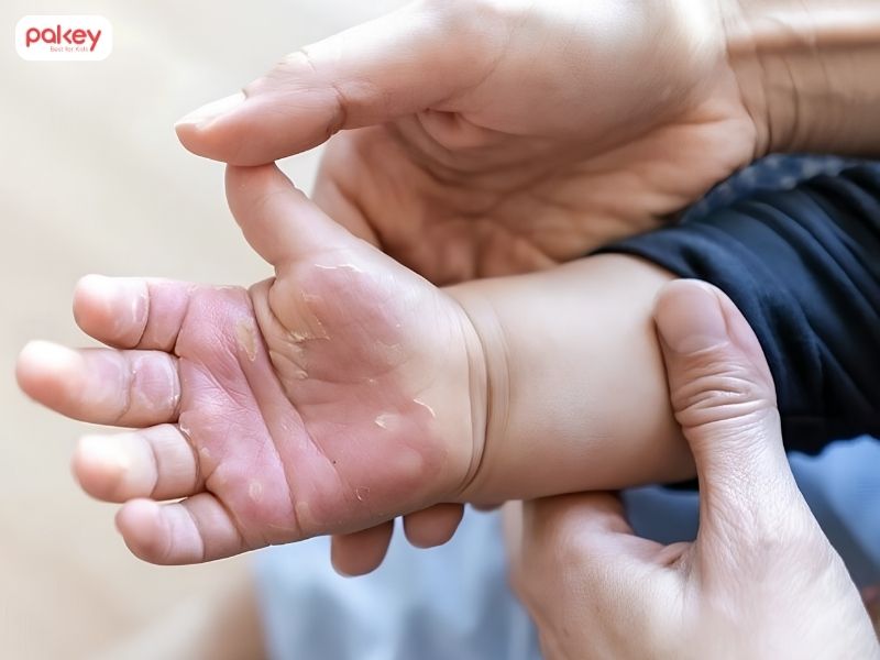 Trẻ bị bỏng phải làm sao và khi nào cần đi viện? 11 Trẻ bị bỏng phải làm sao và khi nào cần đi viện?