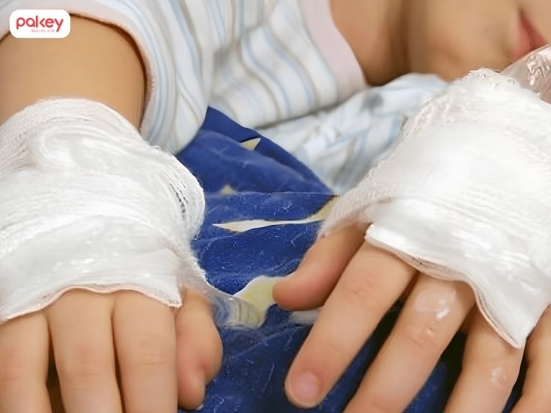 Trẻ bị bỏng phải làm sao và khi nào cần đi viện? 12 Trẻ bị bỏng phải làm sao và khi nào cần đi viện?