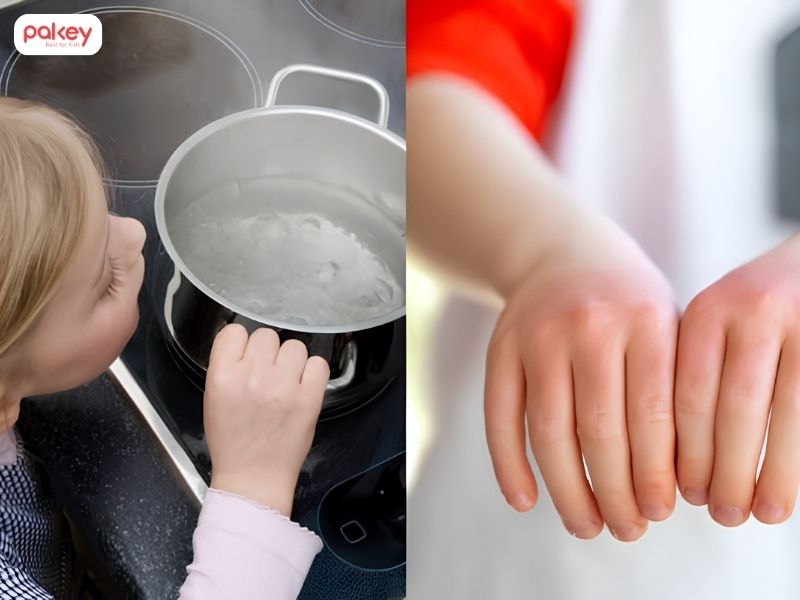 Trẻ bị bỏng phải làm sao và khi nào cần đi viện? 9 Trẻ bị bỏng phải làm sao và khi nào cần đi viện?