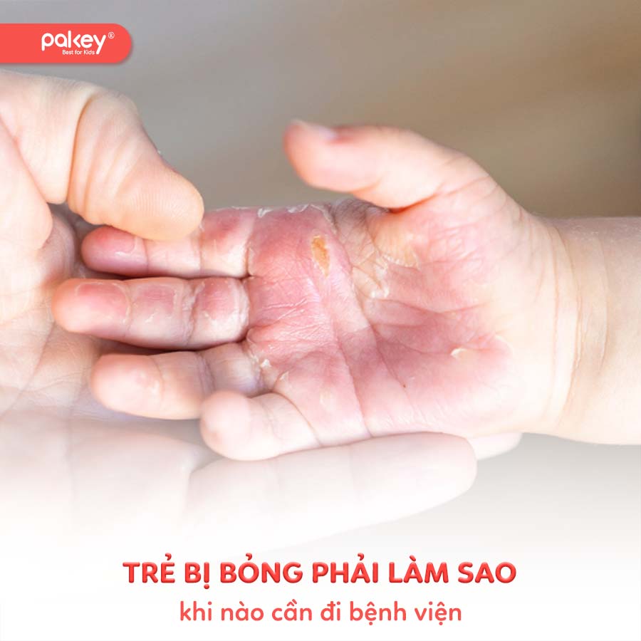Trẻ bị bỏng phải làm sao và khi nào cần đi viện?