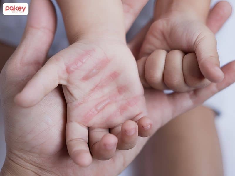 Hướng dẫn cách sơ cứu khi trẻ bị bỏng tại nhà 