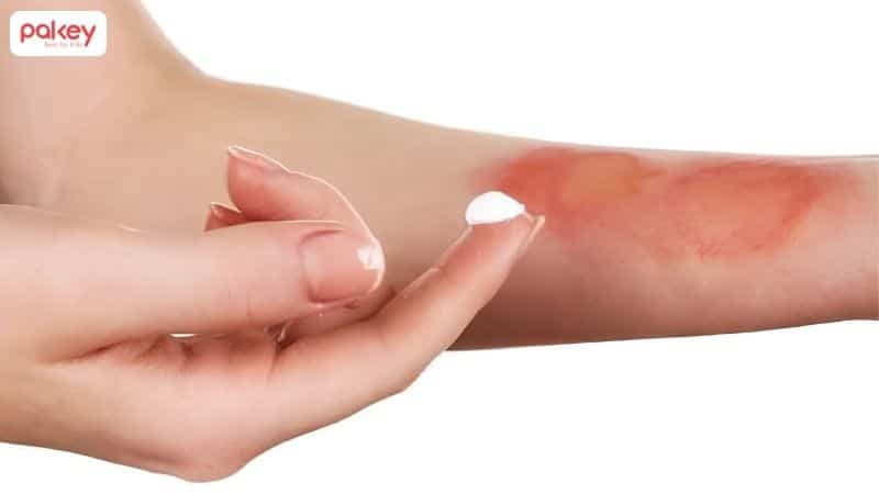 Hướng dẫn cách sơ cứu khi trẻ bị bỏng tại nhà 