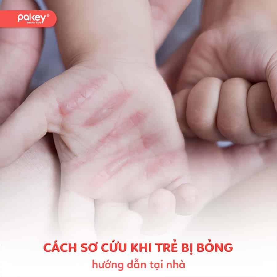 Hướng dẫn cách sơ cứu khi trẻ bị bỏng tại nhà