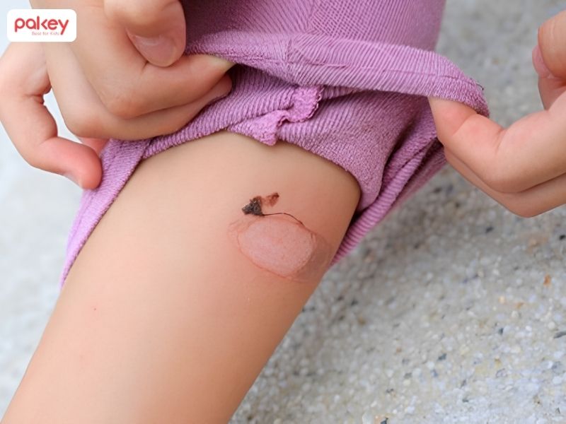 [Giải đáp] Làm gì khi trẻ bị bỏng bô xe máy?