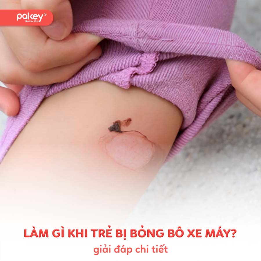 [Giải đáp] Làm gì khi trẻ bị bỏng bô xe máy?