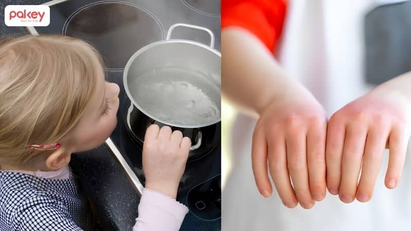 Bỏng hơi là gì? Cách xử lí và phòng tránh khi trẻ bị bỏng hơi 5 Bỏng hơi là gì? Cách xử lí và phòng tránh khi trẻ bị bỏng hơi