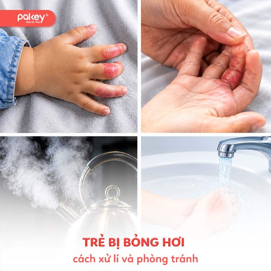 Bỏng hơi là gì? Cách xử lí và phòng tránh khi trẻ bị bỏng hơi