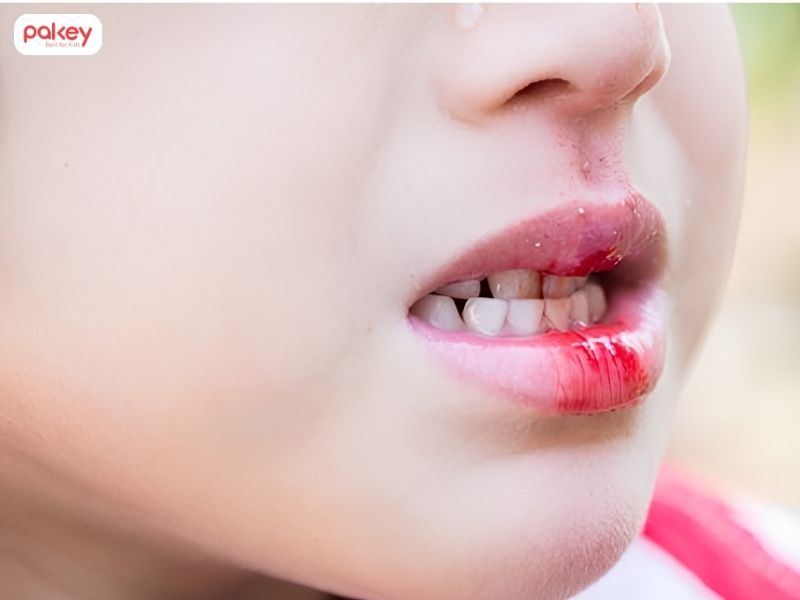 Tổng hợp 9 trường hợp trẻ bị ngã thường gặp và cách xử lý 12 Tổng hợp 9 trường hợp trẻ bị ngã thường gặp và cách xử lý