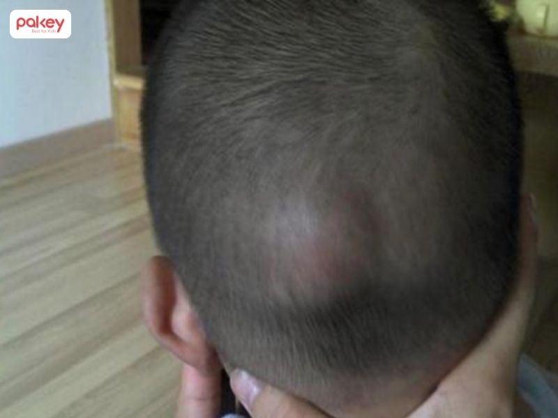 Trẻ bị ngã đập đầu phía sau có nguy hiểm? Khi nào nên đi viện? 6 Trẻ bị ngã đập đầu phía sau có nguy hiểm? Khi nào nên đi viện?