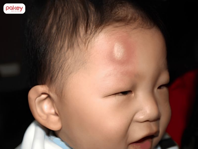 [Giải đáp] Trẻ bị ngã sưng trán có nguy hiểm không?